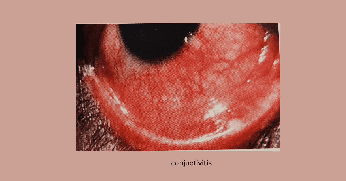 eye conjuctivitis